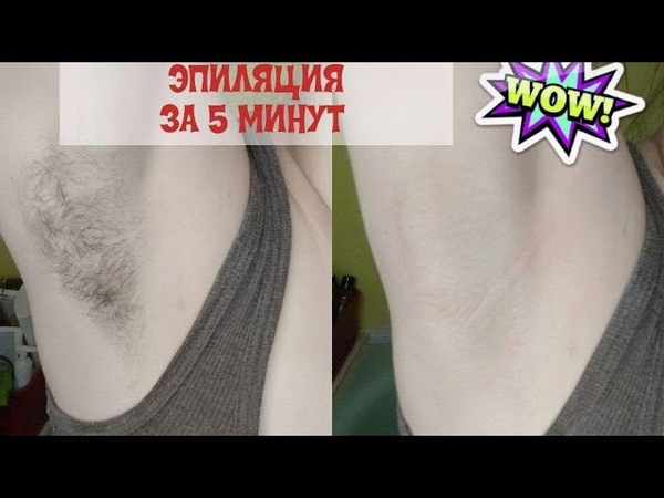 СДЕЛАЛА ЭПИЛЯЦИЮ ЗА 5 МИНУТ , ШУГАРИНГ ПОДМЫШЕК, Алекса
