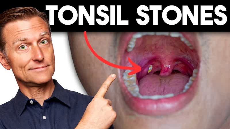 Tonsil Stones: Removing the Deeper