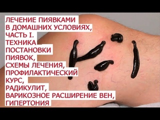Лечение пиявками в домашних условиях, часть I  Техника постановки пиявок, схемы лечения