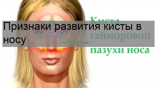 Признаки развития кисты в носу