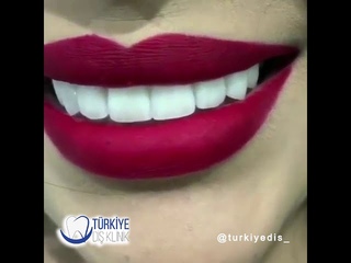 Zirkonyum Diş sonrası estetik gülüş
