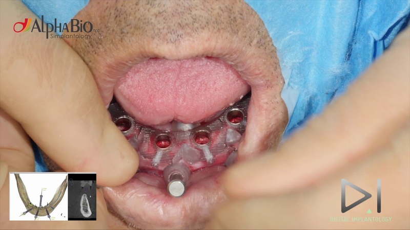 Guided Surgery. Immediate loading in lower jaw, Alpha Bio