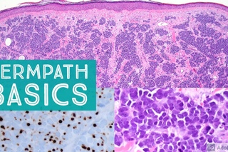 Basic Dermpath Cases 5 - Explained by a Dermatopathologist