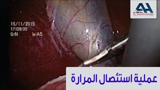 عملية استئصال المرارة الدكتور علاء حسين اž