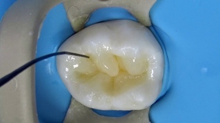 DIRECT RESTORATION]. FIRST MOLAR OF LOWER JAW